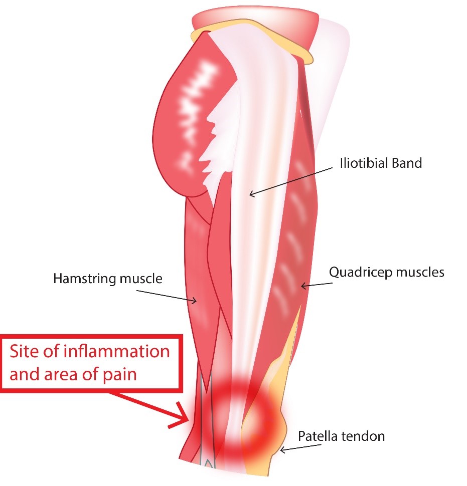 Image Source: http://indianapolisfitnessandsportstraining.com/really-band-friction-syndrome-runners/